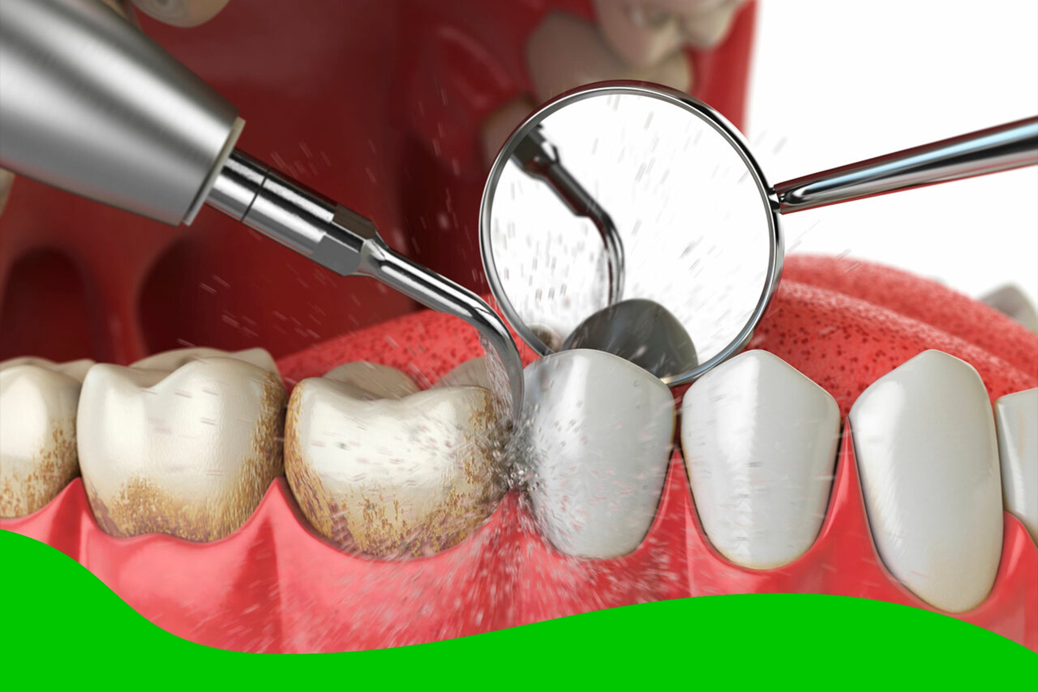 Нужна ли вам чистка зубов у стоматолога